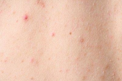 ​艾滋病的皮肤症状是什么？5种异常警示信号，多加留意！