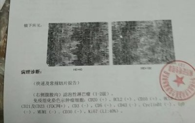 ​升麻鳖甲汤的妙用——恶性肿瘤心生惊恐，中医扶正祛邪控病情