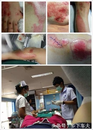 薛之谦车祸受伤照曝光，脚被钢钉刺穿血肉模糊