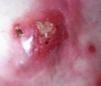 ​痈的概念与特点